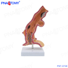 PNT-0748 Ösophagus Pathologie Modell Ösophagus-Anatomie